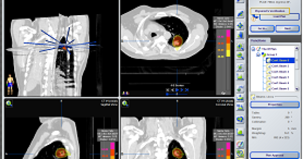SBRT PARA OLIOMETÁSTASIS PULMONAR 