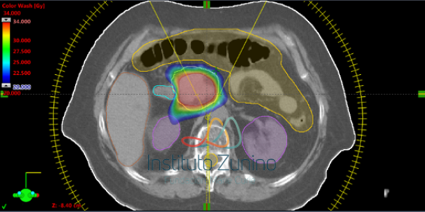 SBRT para cáncer de páncreas