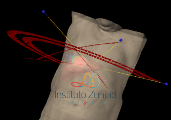 SBRT PARA OLIGOMETÁSTASIS HEPÁTICAS 