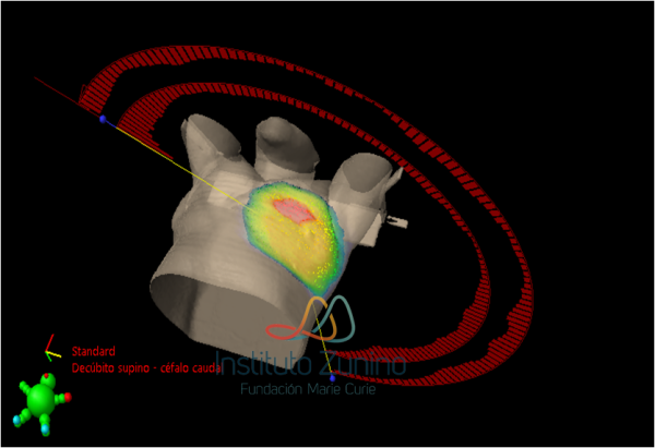 RADIOTERAPIA DE INTENSIDAD MODULADA VOLUMETRICA (VMAT) EN CÁNCER DE MAMA HIPOFRACCIONADA