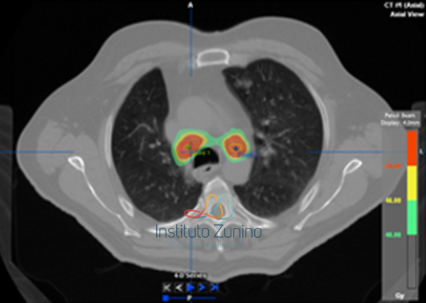 SBRT en tumor residual primario de pulmón después de quimioterapia