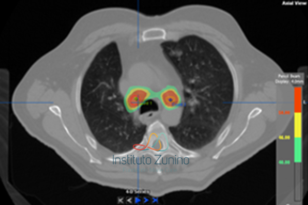 SBRT en tumor residual primario de pulmón después de quimioterapia