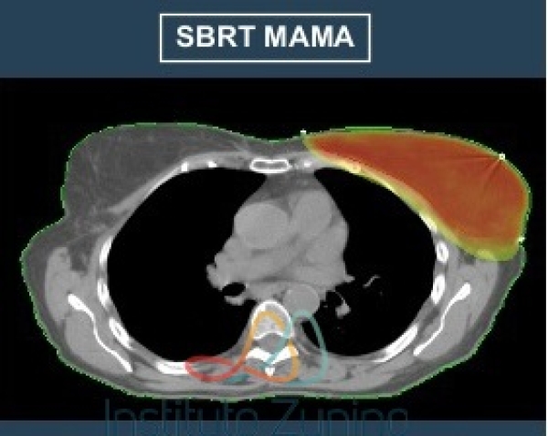 SBRT EN CANCER DE MAMA ESTADIOS TEMPRANOS PARA MUJERES MAYORES DE 70 AÑOS
