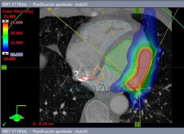 SBRT PARA TAQUICARDIA VENTRICULAR REFRACTARIA